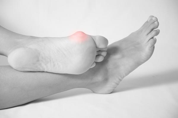 Je commence à avoir des Hallux Valgus !! Est-ce forcément une fatalité? 